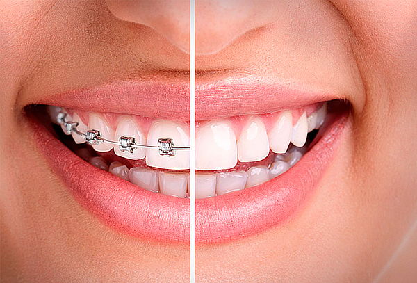 Instalación de Frenillos, Santiago Centro