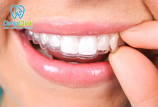 Placa de Relajación para Bruxismo en DentaClick Placa de Relajación para Bruxismo en DentaClick