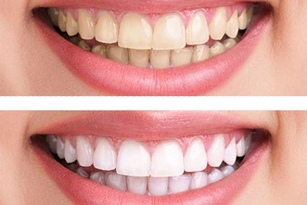 Blanqueamiento o Limpieza dental, Santiago Centro