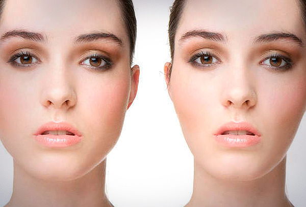 Lipopapada Bichectomia Laser Precio Bichectomia En Clínica Lafourcade