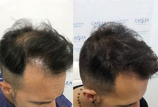 Implante/Cirugía Capilar Técnica FUE