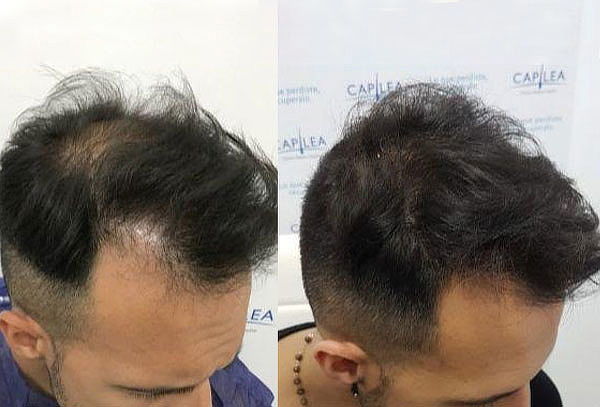 Implante/Cirugía Capilar Técnica FUE