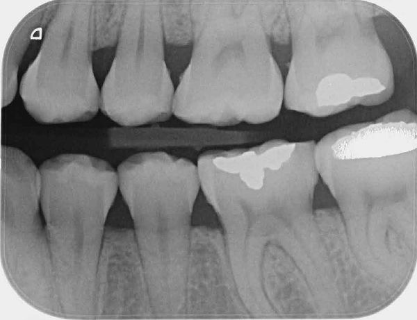 Limpieza Dental + Radiografías Bite Wing + Dcto en Caries