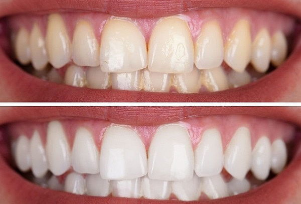 Blanqueamiento dental + Destartraje Supragingival