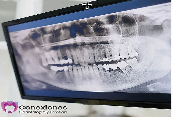 Rx panorámica dental digital + Limpieza profunda | Cuponatic