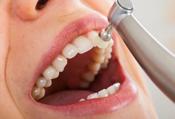 Limpieza Dental: Destartraje + Profilaxis + Flúor. 