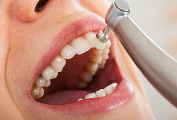 Limpieza Dental: Destartraje + Profilaxis + Flúor. Domingos
