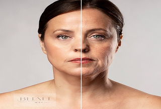 HIFU 7D Ultra Max Facial: Rostro Completo, Cuello y Papada
