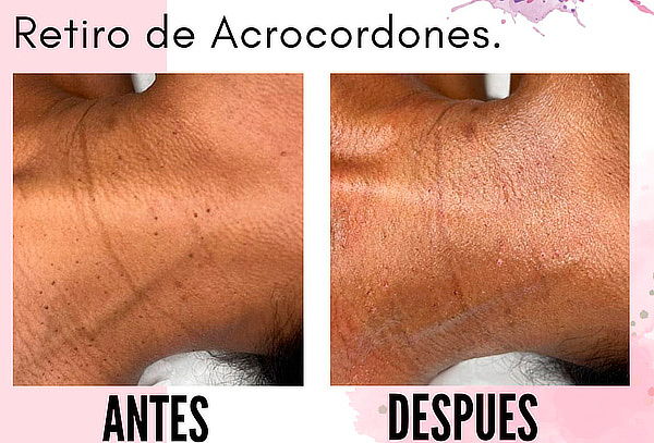 Retiro de Acrocordones con Plasma Pen sin Dolor