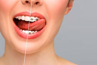 Retiro de Brackets ambas arcadas + Destartraje + Pulido 