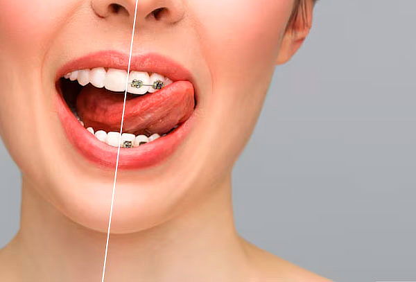 Retiro de Brackets ambas arcadas + Destartraje + Pulido 