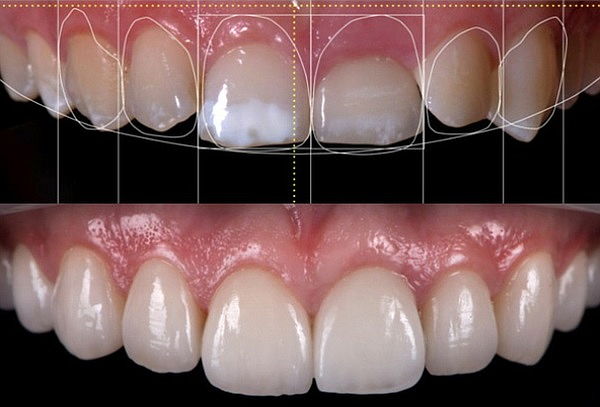 Carilla Dental Directa de Alta Estética