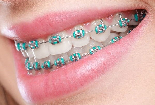 Instalación de Ortodoncia con Brackets Metálicos (Frenillos)
