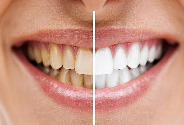 Blanqueamiento Dental + Profilaxis+ Evaluación y Diagnóstico