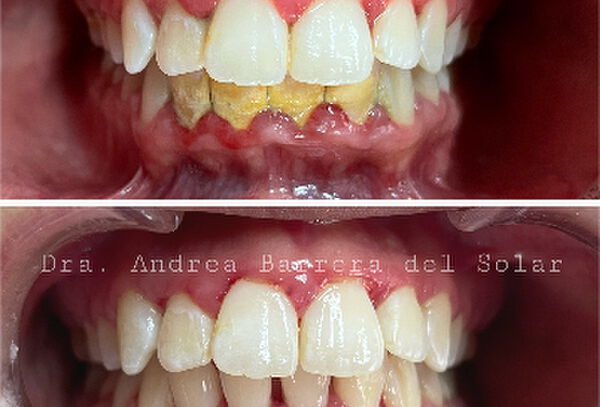 Blanqueamiento dental + limpieza + fluor + radiografias