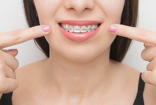 Retiro de Brackets Metálicos, Opcion Contenciones 