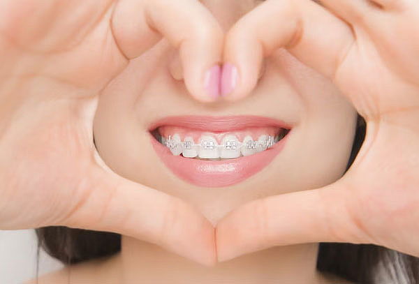 Instalación Ortodoncia de Zafiro