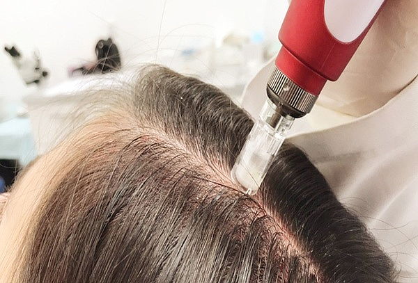 Mesoterapia nutritiva capilar para alopecia y caida de pelo