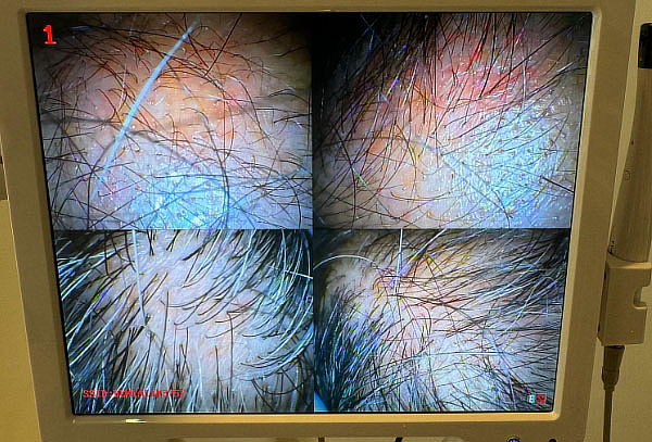 Evaluación,diagnostico Mesoterapia Capilar caida del Cabello