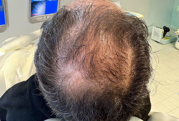 Evaluación,diagnostico Mesoterapia Capilar caida del Cabello