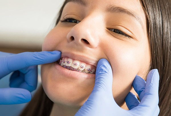 Instalación de Ortodoncia con Brackets Metálicos + Limpieza