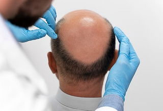 Tratamiento para la Caída del Cabello "Alopecia"