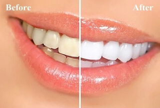 1 Sesión Blanqueamiento dental Led + Profilaxis 