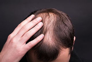  Alopecia con plasma en Grupo Bari Salud Spa, Santiago
