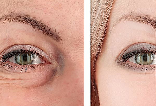 Rejuvenece tu Rostro con Toxina Botulínica en Novalife