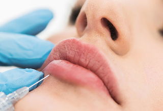 Armonización de Labios con Ácido Hialurónico en Novalife