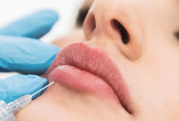 Armonización de Labios con Ácido Hialurónico en Novalife