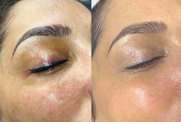 Bbglow, disfruta de una piel de porcelana en Ikigai Estetica