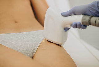 6 Sesiones de depilación laser Diodo rebaje y axilas