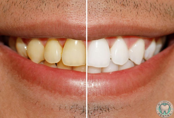 Limpieza + Blanqueamiento Dental LED 3 Aplicaciones .....
