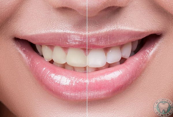 Limpieza + Blanqueamiento Dental LED 3 Aplicaciones .....