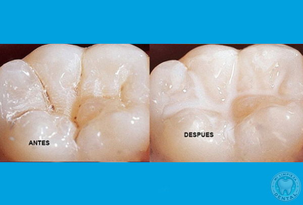 Sellantes Dental