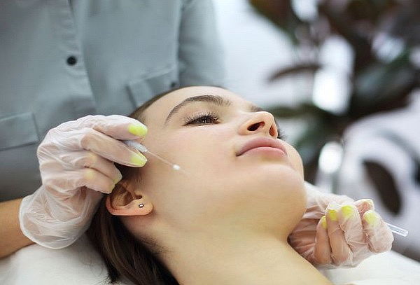 Rejuvenecimiento facial con Hilos Revitalizantes