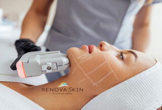 1 sesión HIFU Coreano  + Terapia Celluma Pro, ¡Adiós Papada!
