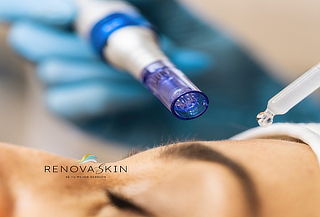 Exosomas con dermapen + Limpieza facial +Terapia led