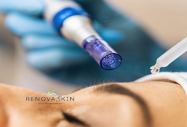 Exosomas con dermapen + Limpieza facial +Terapia led