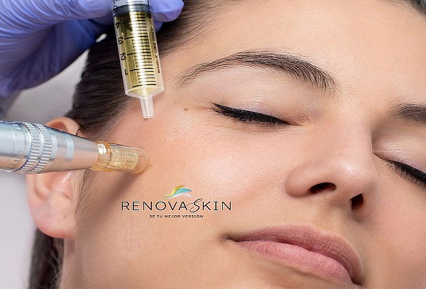 Exosomas con dermapen + Limpieza facial +Terapia led