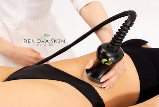 6 sesiones de Lipo sin Cirugia abdomen + Espalda + Drenaje