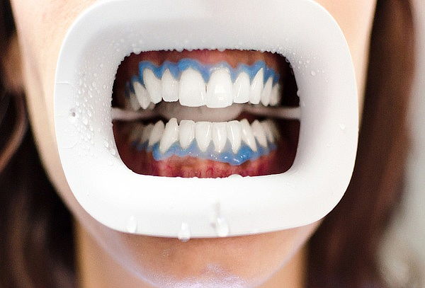 Limpieza + Blanqueamiento Dental + Diagnostico