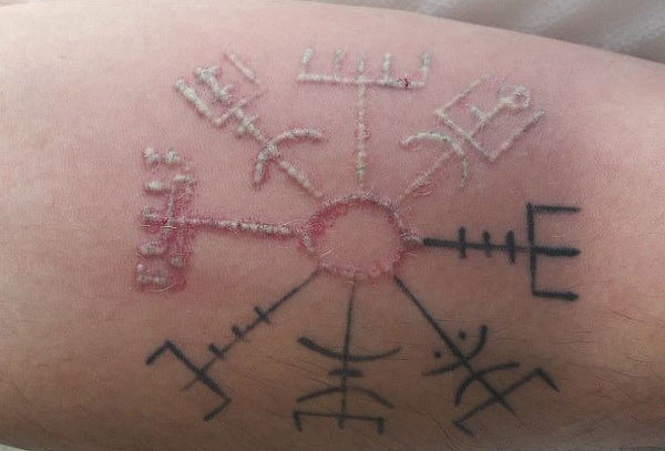 3 Sesiones de Borrado de Tatuaje hasta 5cm x 5cm