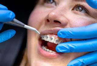 Instalación de Brackets + Limpieza Dental 