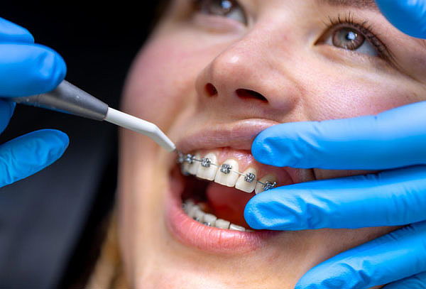 Instalación de Brackets + Limpieza Dental 