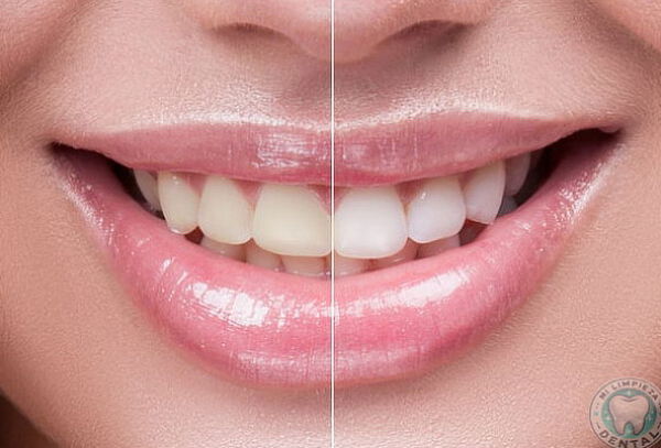 Blanqueamiento Dental + Limpieza + Profilaxis + Destartraje 