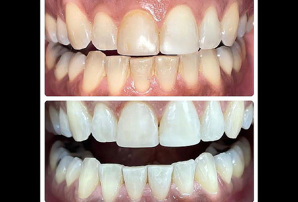 1, 2 o 3 Sesiones de Blanqueamiento Led + Limpieza Dental