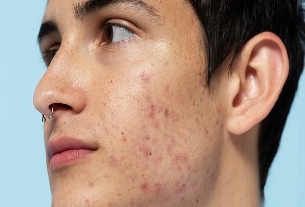 3 Sesiones Peeling Facial + Limpieza facial