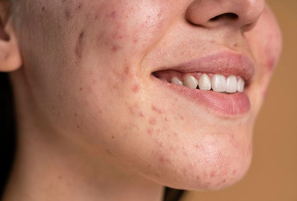 3 Sesiones Peeling Facial + Limpieza facial